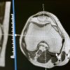 CT Machine Tubes: The Heart of Imaging and What to Do When Replacement is Needed